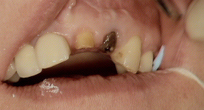 Implantatprothetik unter erschwerten Bedingungen