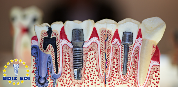 Entzündung am Implantat – schicksalhaft oder vermeidbar?