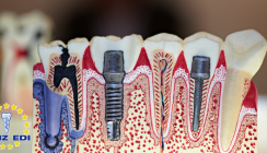 Entzündung am Implantat – schicksalhaft oder vermeidbar?