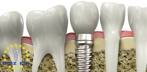 Neuer Leitfaden zum Umgang mit kurzen und angulierten Implantaten