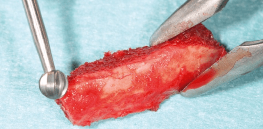 Morbidität nach Entnahme von autologem Beckenknochen