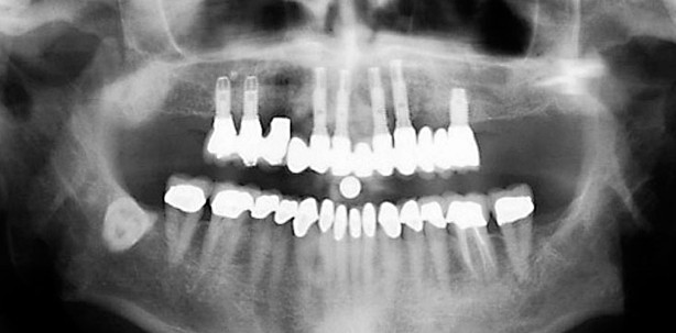 Grundlegende Parameter der Behandlungsplanung beim zahnlosen Oberkiefer