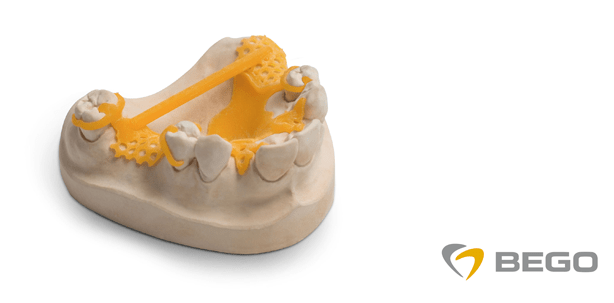 CAD/Cast-Modellgussgerüste – einfach, schnell und präzise im Labor gedruckt