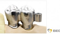 Neu bei BEGO: CAD/CAM-Doppelkronen