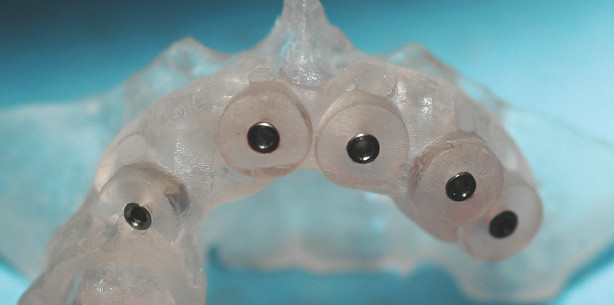 Sicher lächeln – nie wieder ohne Zähne