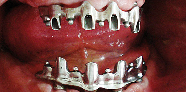 Deckprothesen mit Steganker