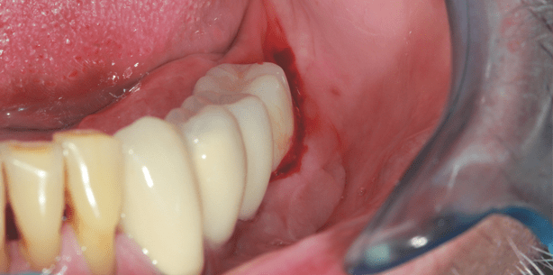 Behandlungsstrategien periimplantärer Entzündungen