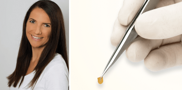 Intensivkur mit PerioChip® überzeugt Zahnärzte und Patienten