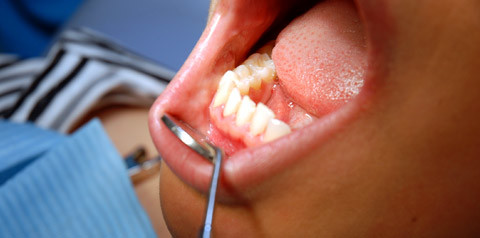 Herzinfarktrisiko bei Zahnfleischentzündung