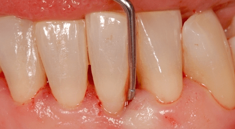 Der doppelte Spaltlappen