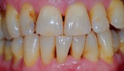 Von der Prävention zur Erhaltungstherapie