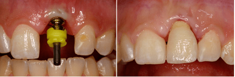 Ästhetische Erfolgsfaktoren in der Implantatprothetik