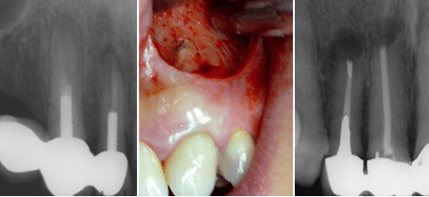 Aktuelle Trends der Wurzelspitzenresektion