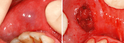 Die Behandlung von Retentionszysten