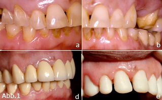Laser in der kosmetisch-ästhetischen Zahnheilkunde