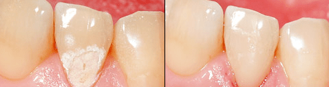 Mikroinvasive Zahnhartsubstanzbearbeitung