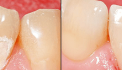 Mikroinvasive Zahnhartsubstanzbearbeitung