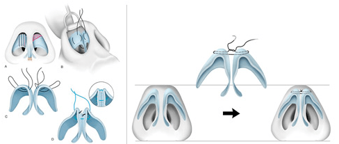 2. Rhinoplastik – Die Luxationstechnik