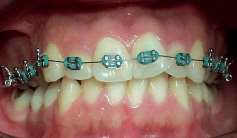 Effizienter Einsatz lingualer Orthodontie bei rotierten Zähnen