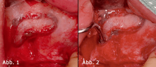 Ist der laterale Sinuslift eine gefahrlose Methode?