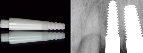 Zirkoniumdioxid Keramikimplantate