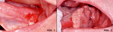Mundkrebsfrüherkennung - eine tägliche Herausforderung