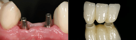 Sofortimplantation und -versorgung im UK-Bereich
