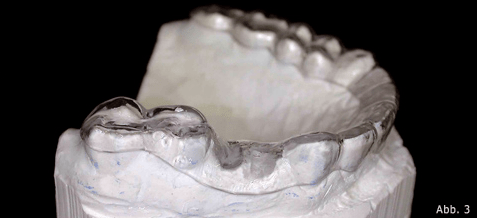 Medikamentös verursachte Blutgerinnungsstörungen