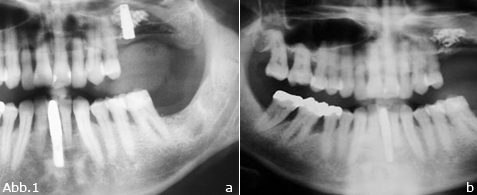 Knochenregeneration: Aufklärungspflicht zu Risiken und Komplikationen