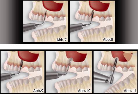 Eine minimalinvasive Methode zur Sinusbodenelevation