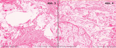 Monophasischer Hyaluronsäurefiller