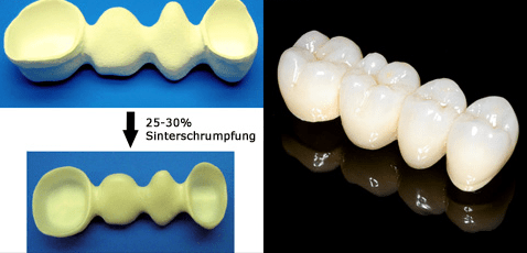 Zirkoniumdioxid - Eine Keramik auf dem Weg zum Goldstandard