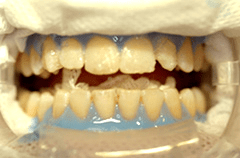 Minimalinvasiv zum strahlenden Weiß