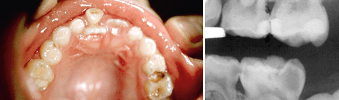 Endontie im Milchgebiss