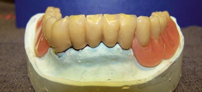 Digitale Abformung von Primärkronen aus Zirkonoxid