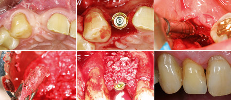Knochengewinnung einfach und effizient