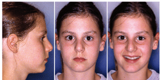 Funktionskieferorthopädische Therapie