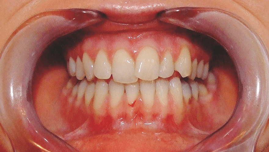 Parodontitis korrelierte endokrinologische Veränderungen