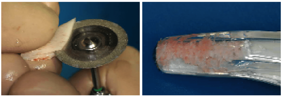 Knochen dreidimensional aufbauen