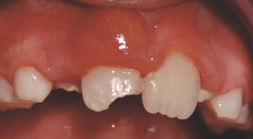 Regenerative Endodontie