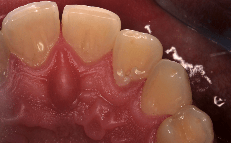 Behandlung eines Dens invaginatus