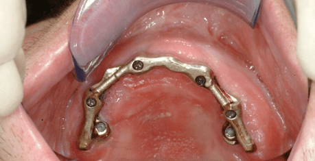 Bösartiger Tumor am Mundboden und Unterkiefer