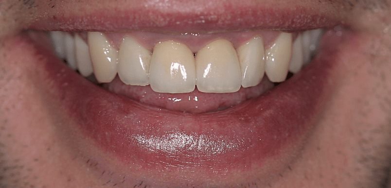 Chronische hyperplastische Gingivitis