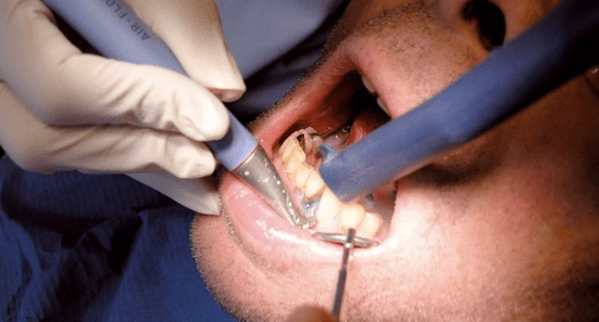 Laser in der Zahnheilkunde - Ein Überblick