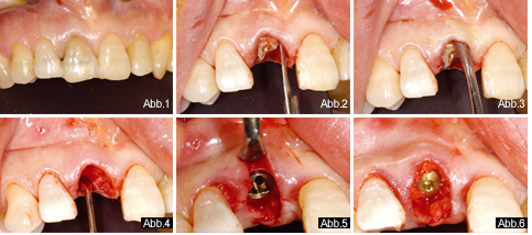 Die gesteuerte Knochenregeneration