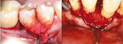 Fehlervermeidung in der Parodontalchirurgie