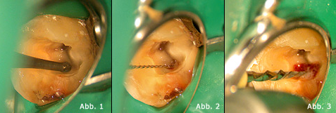 Problemmanagement in der Endodontie