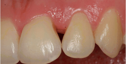 Der vertikale Knocheneinbruch am Parodont