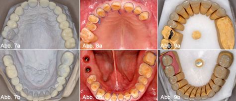 Rehabilitation eines Abrasionsgebisses