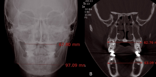 Nichtoperative maxilläre Expansion